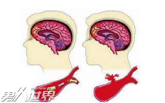 老人出现脑溢血的症状有哪些