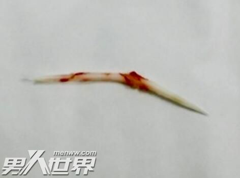 女子硬吞饭团把鱼刺扎进主动脉