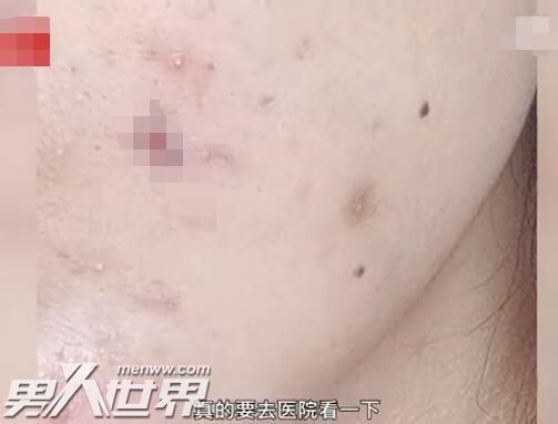 女子挤痘痘脸部感染手术缝6针